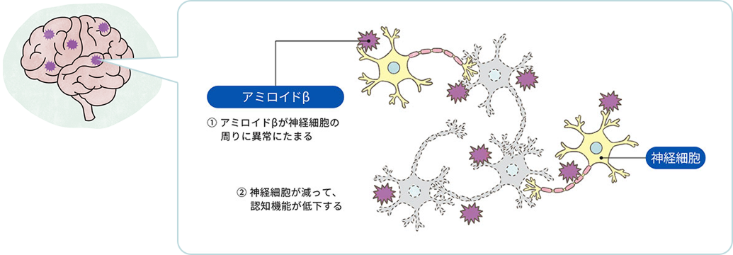 アミロイドβ（ベータ）の図　脳にアミロイドβ（ベータ）が異常にたまることで、脳の神経細胞が減り、認知機能が低下する
