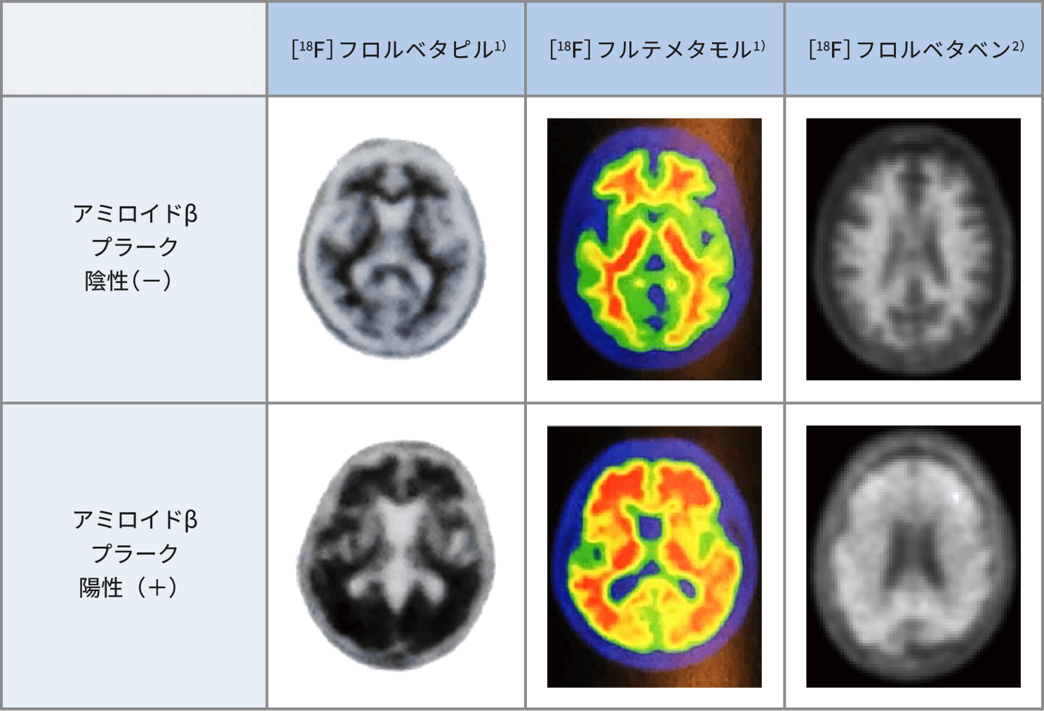 脳のアミロイドβの蓄積の程度を調べるアミロイドPET検査の画像